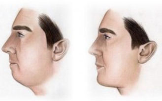 brada i jagodice Poliklinika Aesthete zagreb - Plastična kirurgija - Estetski zahvati i tretmani kože, lica i tijela
